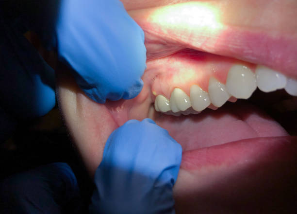 Best Knocked-Out Tooth (Avulsed Tooth) Treatment in Belle, WV